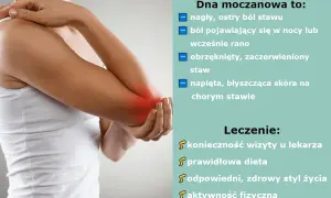 Dna moczanowa: Ulga bez recepty? Co naprawdę działa na ból