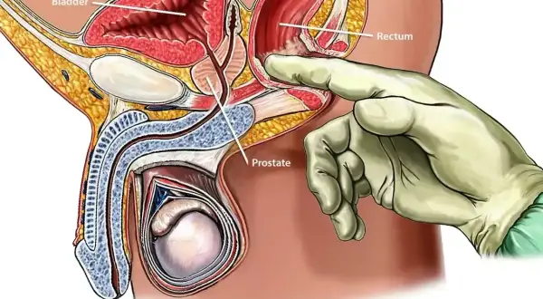 Ilustracja anatomiczna pokazująca badanie per rectum. Dłoń w rękawiczce dotyka prostaty przez odbytnicę.