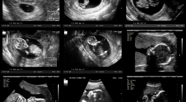 Ile czekać na wyniki badań prenatalnych? Wszystko, co musisz wiedzieć.