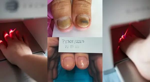 Grzybica paznokci: Od lakieru po laser co wyleczy ją na stałe?