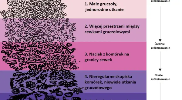 Skala Gleasona ilustruje wyniki biopsji prostaty, pokazując stopnie zróżnicowania komórek od 1 do 5.