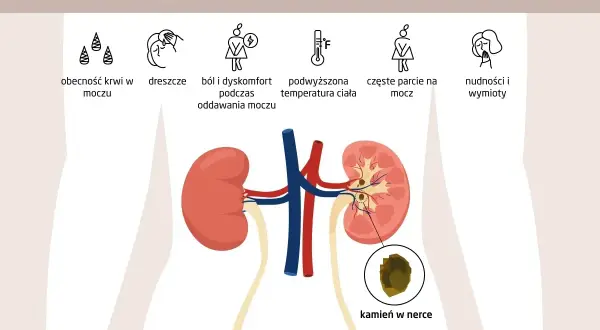 Diagnostyka kamicy nerkowej: Jakie badania i co oznaczają?